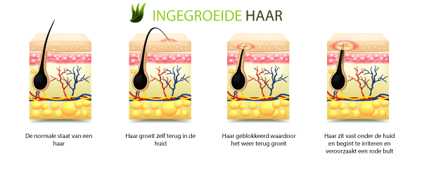 Ingegroeide haar infographic